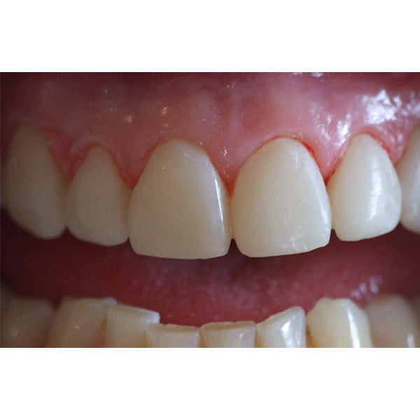 After picture having closed a large gap between front teeth