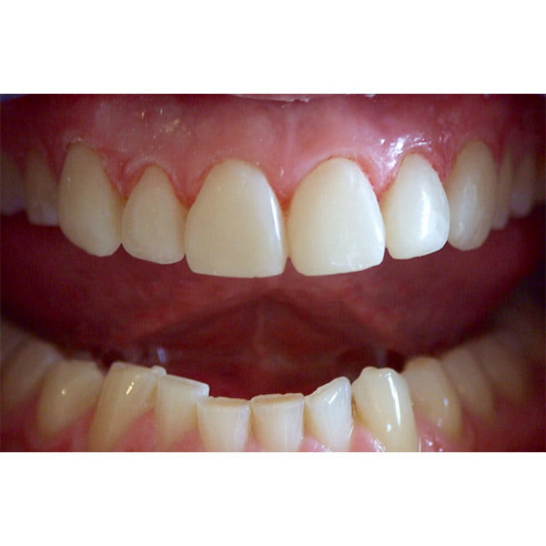 After picture having closed a large gap between front teeth