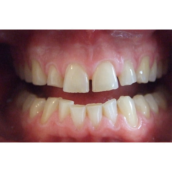 Before picture of large gap between front teeth