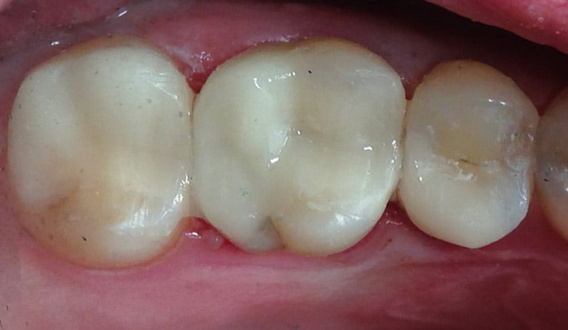 Up close image of the tops of teeth in the mouth