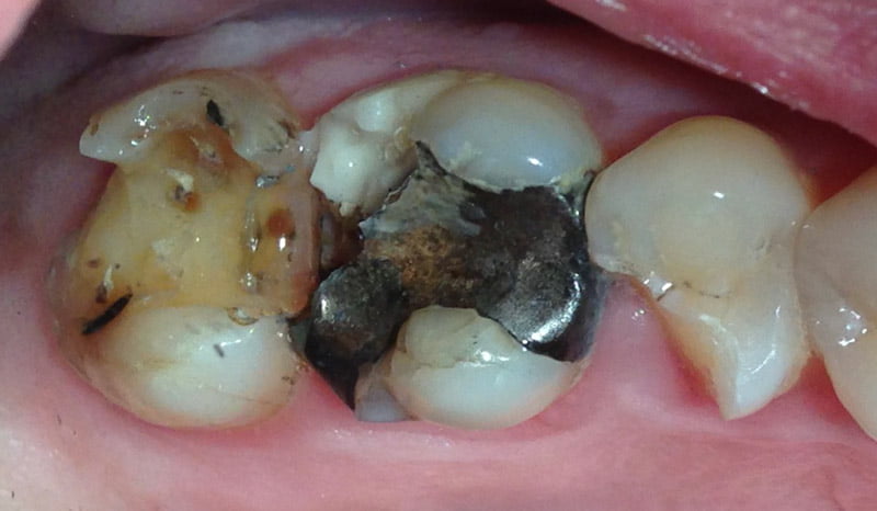 Up close image of damaged and decayed teeth in the mouth