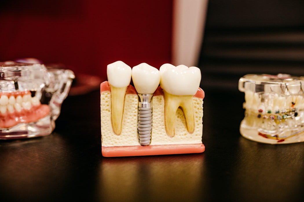 Model of teeth and dental implants